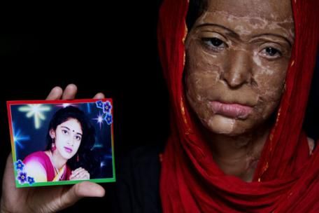 acid-attack-3 দেশে অ্যাসিড হামলায় শীর্ষে বাংলা, বলছে তথ্য